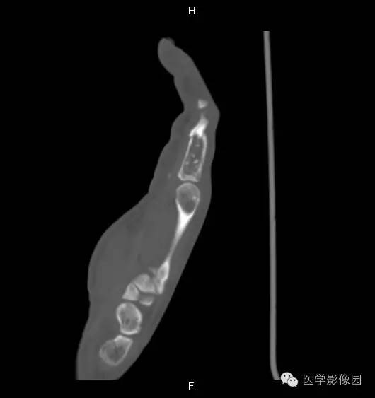【病例】指骨内生性软骨瘤1例X线及CT影像表现