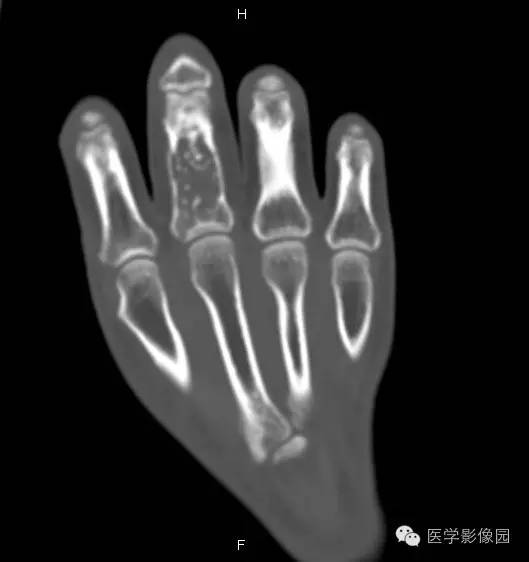 【病例】指骨内生性软骨瘤1例X线及CT影像表现