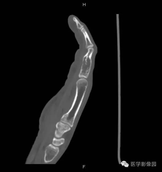 【病例】指骨内生性软骨瘤1例X线及CT影像表现