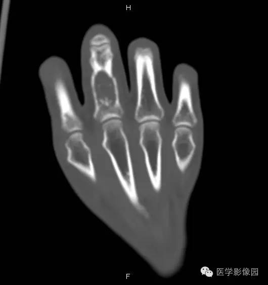 【病例】指骨内生性软骨瘤1例X线及CT影像表现