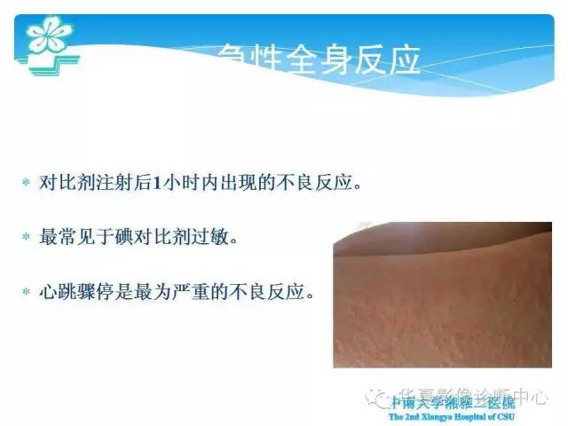 【PPT】碘对比剂不良反应的急救与预防
