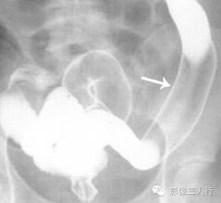 "铅管征"，这个征象提示啥？