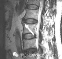 99%的人都见过的腰椎间盘一个现象,但很多人不知道原因 99%的人都见过的腰椎间盘一个现象,但很多人不知道原因