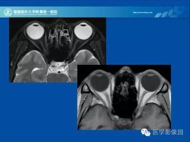 【PPT】眼眶病变的MR检查技术及诊断