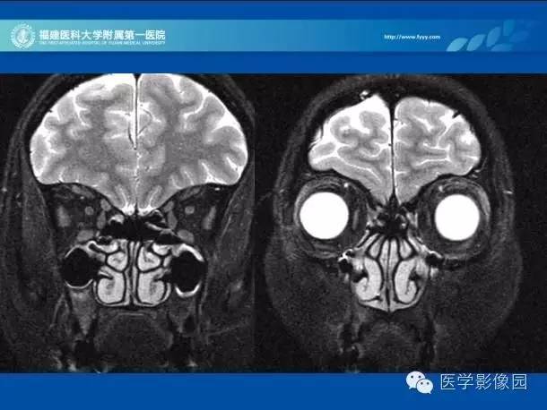 【PPT】眼眶病变的MR检查技术及诊断