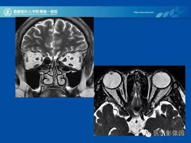 【PPT】眼眶病变的MR检查技术及诊断