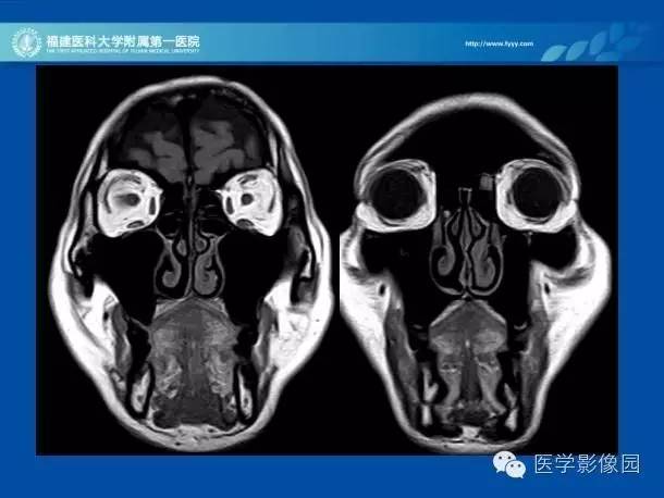 【PPT】眼眶病变的MR检查技术及诊断