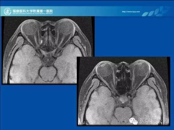 【PPT】眼眶病变的MR检查技术及诊断
