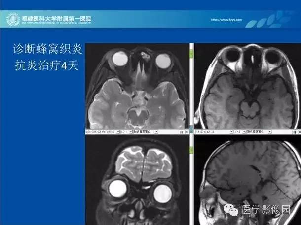 【PPT】眼眶病变的MR检查技术及诊断