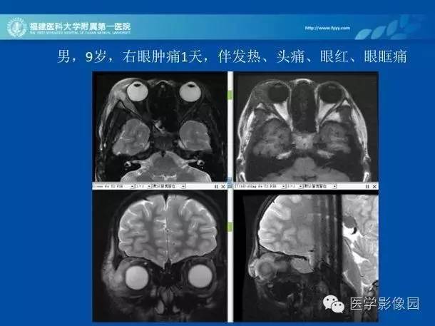【PPT】眼眶病变的MR检查技术及诊断