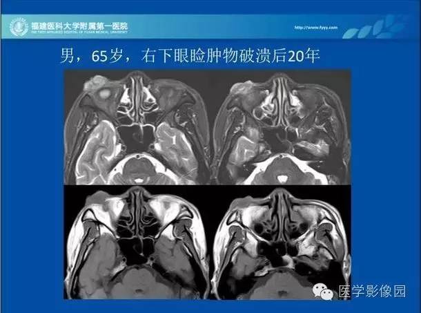 【PPT】眼眶病变的MR检查技术及诊断