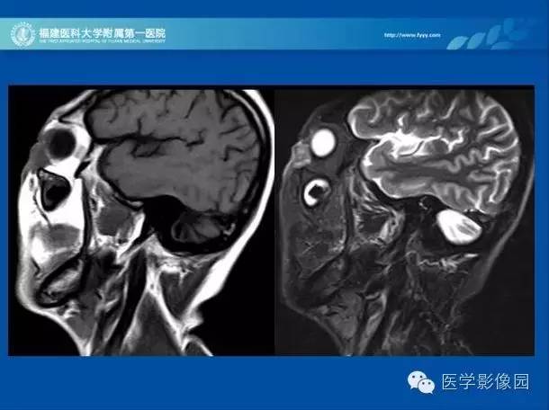 【PPT】眼眶病变的MR检查技术及诊断