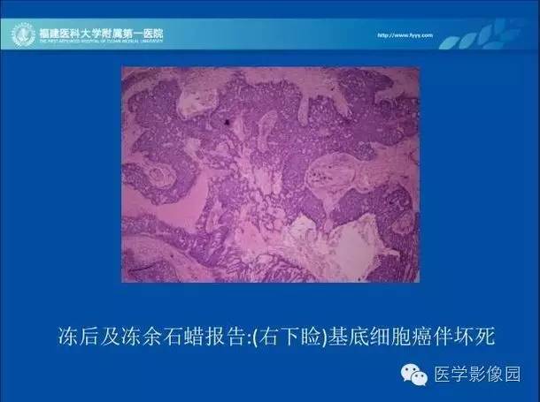 【PPT】眼眶病变的MR检查技术及诊断