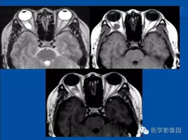 【PPT】眼眶病变的MR检查技术及诊断
