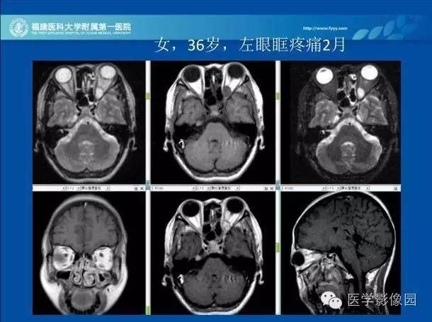 【PPT】眼眶病变的MR检查技术及诊断
