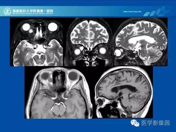 【PPT】眼眶病变的MR检查技术及诊断