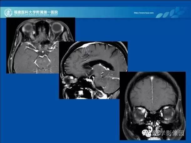【PPT】眼眶病变的MR检查技术及诊断