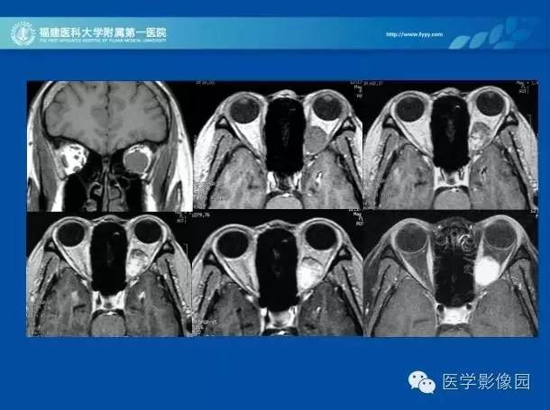 【PPT】眼眶病变的MR检查技术及诊断