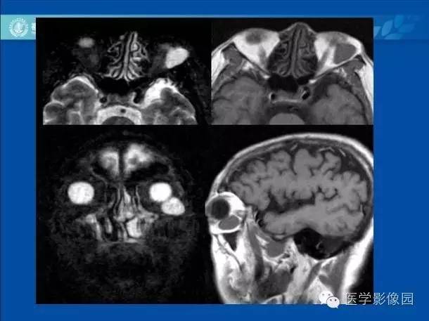 【PPT】眼眶病变的MR检查技术及诊断