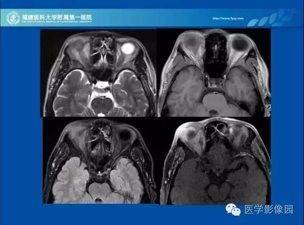 【PPT】眼眶病变的MR检查技术及诊断
