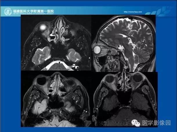 【PPT】眼眶病变的MR检查技术及诊断