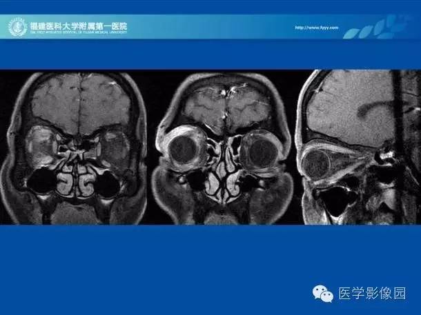【PPT】眼眶病变的MR检查技术及诊断