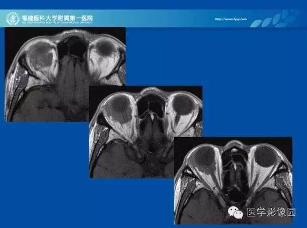 【PPT】眼眶病变的MR检查技术及诊断
