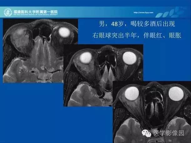 【PPT】眼眶病变的MR检查技术及诊断
