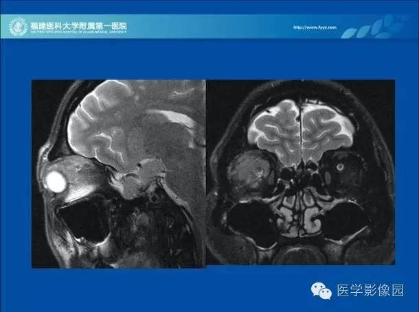 【PPT】眼眶病变的MR检查技术及诊断
