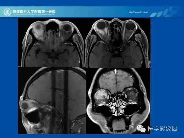 【PPT】眼眶病变的MR检查技术及诊断