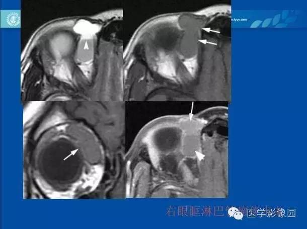【PPT】眼眶病变的MR检查技术及诊断