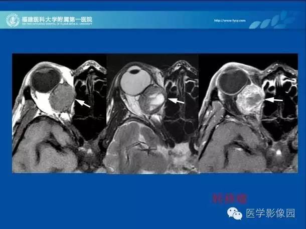【PPT】眼眶病变的MR检查技术及诊断