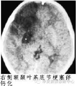 基底节区钙化是儿童外伤后脑梗塞的重要提示性征象 基底节区钙化是儿童外伤后脑梗塞的重要提示性征象