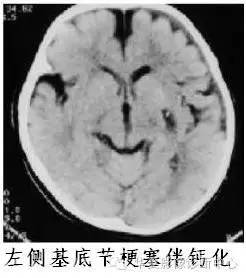 基底节区钙化是儿童外伤后脑梗塞的重要提示性征象
