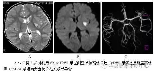 基底节区钙化是儿童外伤后脑梗塞的重要提示性征象 基底节区钙化是儿童外伤后脑梗塞的重要提示性征象