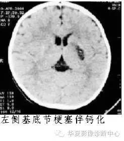 基底节区钙化是儿童外伤后脑梗塞的重要提示性征象 基底节区钙化是儿童外伤后脑梗塞的重要提示性征象