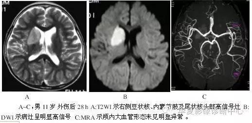 基底节区钙化是儿童外伤后脑梗塞的重要提示性征象 基底节区钙化是儿童外伤后脑梗塞的重要提示性征象