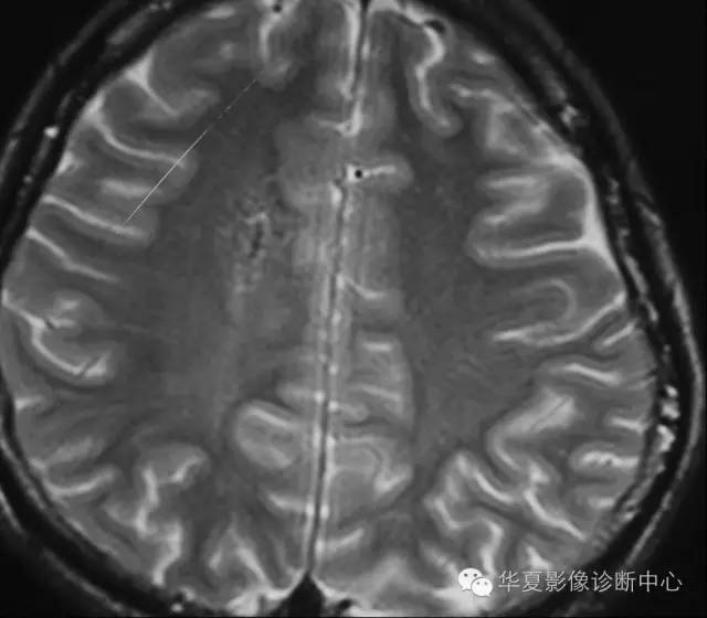 “水母头”征是脑静脉血管畸形重要提示性征象 “水母头”征是脑静脉血管畸形重要提示性征象