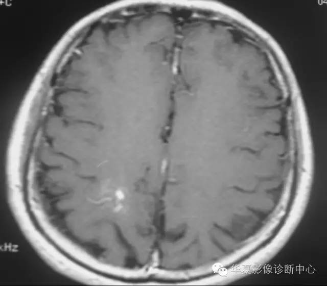 “水母头”征是脑静脉血管畸形重要提示性征象 “水母头”征是脑静脉血管畸形重要提示性征象