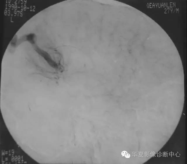 “水母头”征是脑静脉血管畸形重要提示性征象 “水母头”征是脑静脉血管畸形重要提示性征象