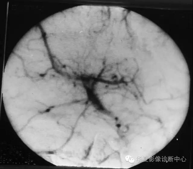 “水母头”征是脑静脉血管畸形重要提示性征象 “水母头”征是脑静脉血管畸形重要提示性征象