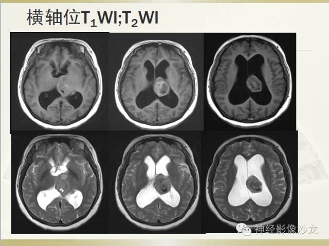 【病例】颅内神经元错构瘤1例CT及MR影像表现