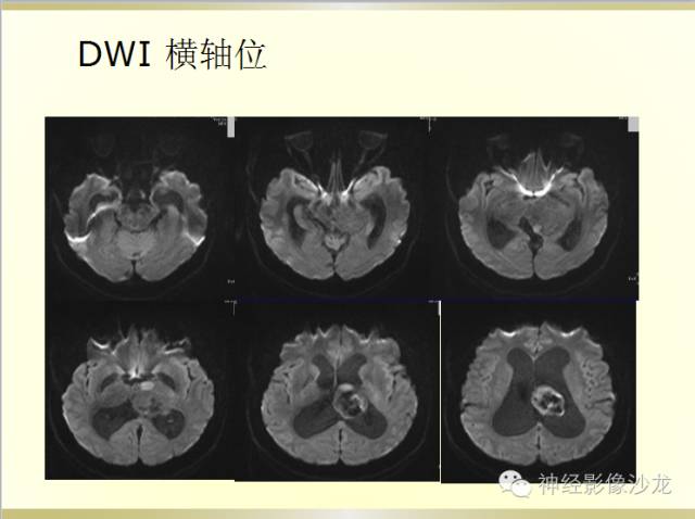 【病例】颅内神经元错构瘤1例CT及MR影像表现