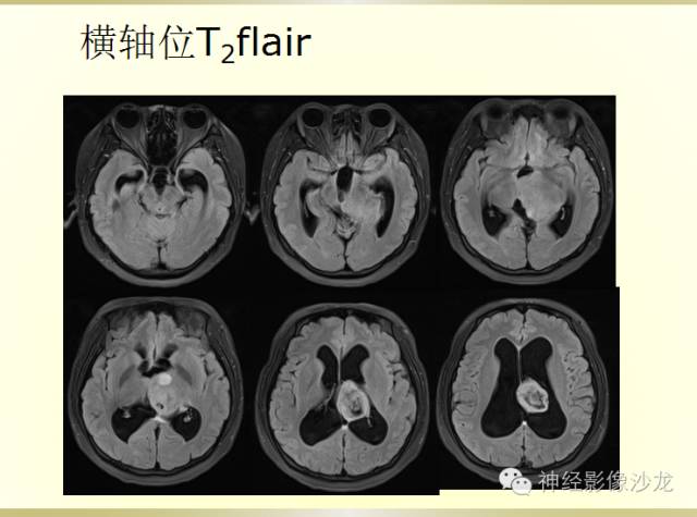 【病例】颅内神经元错构瘤1例CT及MR影像表现