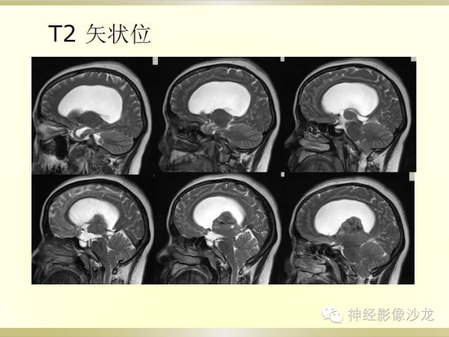 【病例】颅内神经元错构瘤1例CT及MR影像表现
