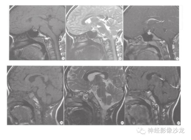 【病例】颅内神经元错构瘤1例CT及MR影像表现