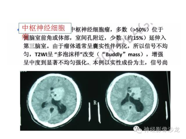 【病例】颅内神经元错构瘤1例CT及MR影像表现