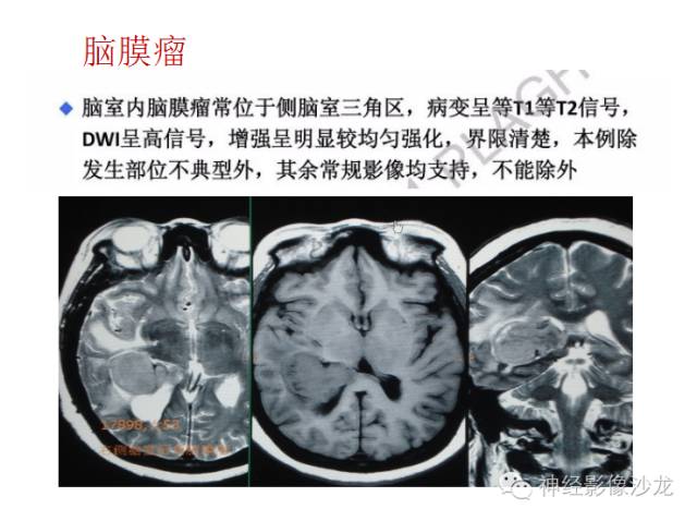 【病例】颅内神经元错构瘤1例CT及MR影像表现