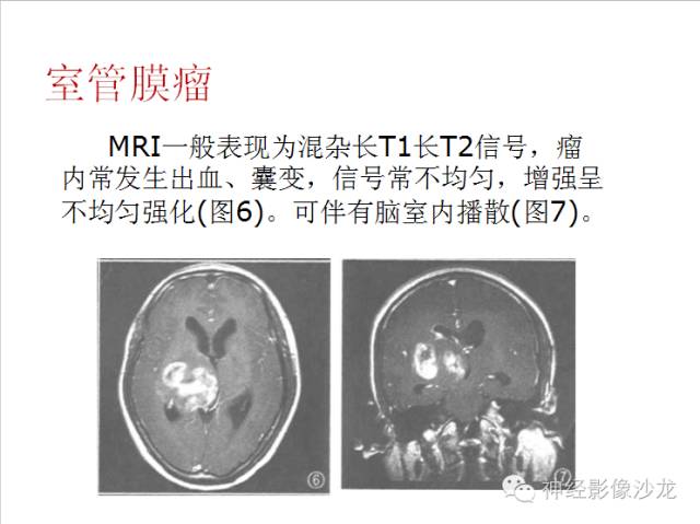 【病例】颅内神经元错构瘤1例CT及MR影像表现