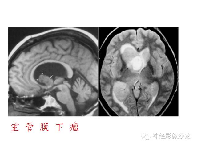 【病例】颅内神经元错构瘤1例CT及MR影像表现